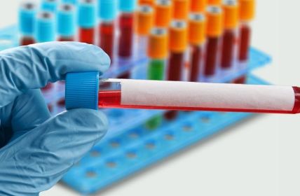 BD-tau Blutmarker misst frühzeitig Schlaganfallfolgen und prognostiziert Genesungschancen (Foto: AdobeStock - BillionPhotos.com - 486404804)